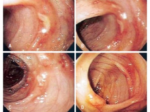 Allergic proctocolitis