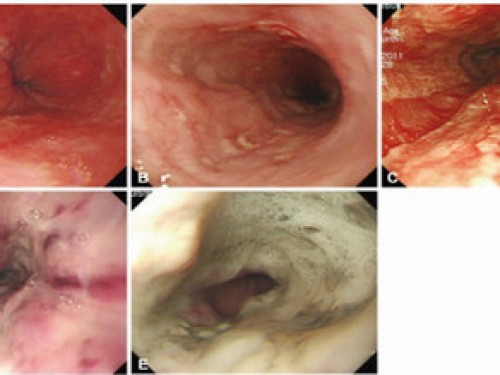 Zagar classification for corrosive ingestion