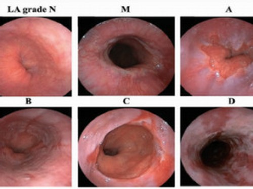 Grading classification of reflux esophagitis